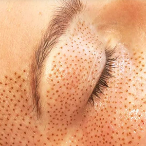 Fibroblast Plasmalift