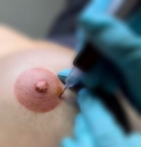 Tepelhofreconstructie