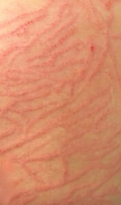 Zwangerschapsstriemen