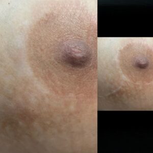 Tepelhofreconstructie